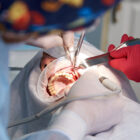 Regeneración Ósea Dental