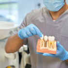 Implantes dentales, ventajas, riesgos…