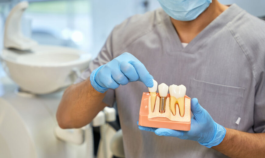 implantes dentales ventajas riesgos